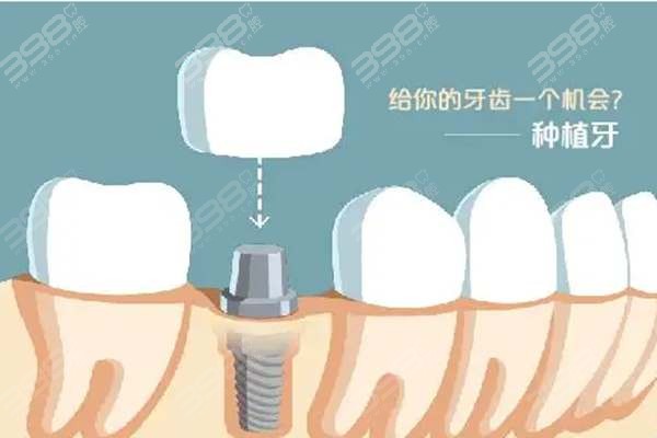 全球种植牙材料市场概览，哪个国家种植牙材料领先全球？