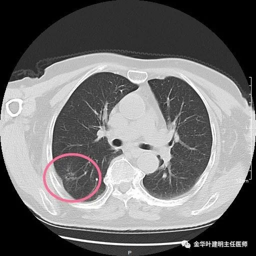 女子肺部磨玻璃结节癌变理赔遭拒，健康险保障盲区与应对策略探讨