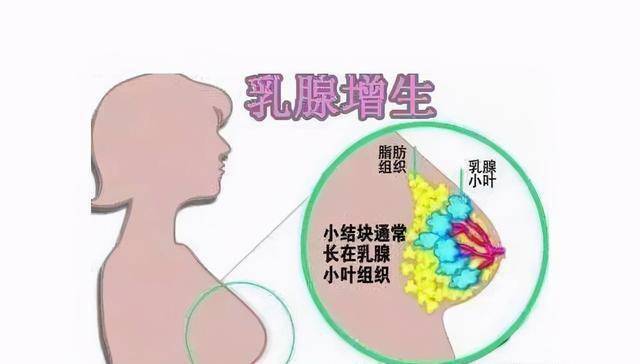 36岁女子胸部疙瘩揭示乳腺癌，早期发现与积极应对至关重要