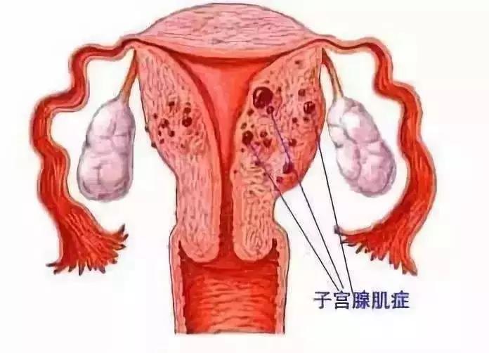 痛经困扰下的抉择，子宫切除背后的故事与思考