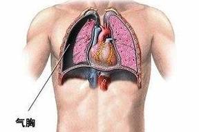 气胸详解，了解、应对及预防措施