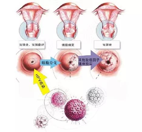 女生做了人工阴道后仍感染HPV